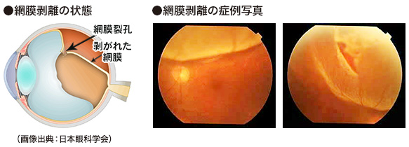 網膜剥離の状態図と症例写真