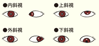 斜視の種類（内斜視・外斜視・上斜視・下斜視）の図